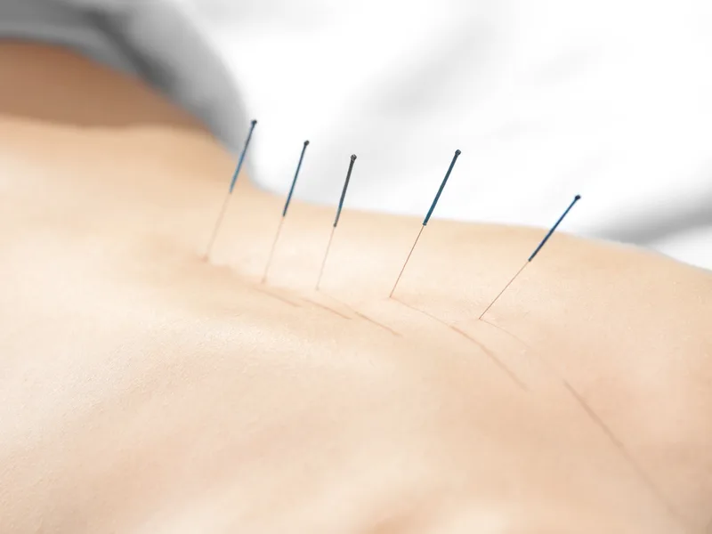 Acupuncture at Lincoln Park Rehab in Miramar