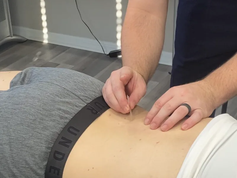 How Dry Needling works at Lincoln Park Rehab