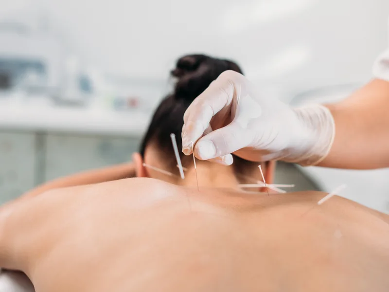 Dry Needling at Lincoln Park Rehab in Miramar